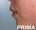 Prima dell'intervento di ortodonzia (profilo)
