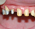 Situazione iniziale:paziente portatore di scheletrato con ganci inestetici. Parte dei denti restanti sono ricoperti con vecchie corone fisse