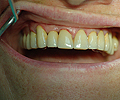 Risultato finale con l'effetto di continuità dei denti senza la presenza inestetica di ganci metallici