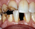 Situazione iniziale: notevole perdita di volume di diversi elementi dentali e mancanza di un incisivo inferiore