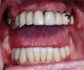 Situazione iniziale:paziente portatore di scheletrato con ganci inestetici.parte dei denti restanti sono ricoperti con vecchie corone fisse