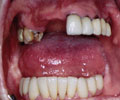 Si nota la grave carie del primo molare superiore