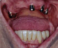 Vengono mantenuti i denti sani superiore,limati e ricoperti con corone telescopiche