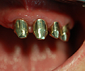 I quattro denti residui vengono limati e le corone telescopiche primarie vengono cementate su di essi