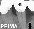 Perdita di osso distale al secondo premolare inferiore(45)